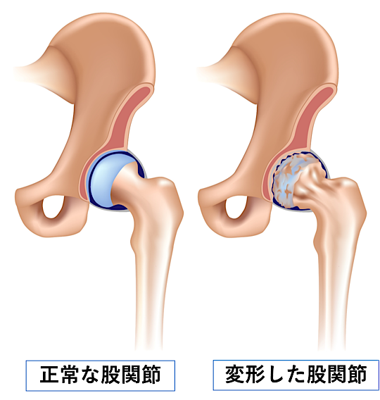 リハビリの専門家が教える 股関節痛改善 トレーニングのポイント コラム パーソナルジム Activate Gym 静岡市葵区と浜松市中区